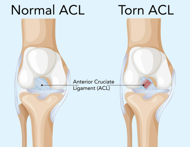Ligament Reconstruction